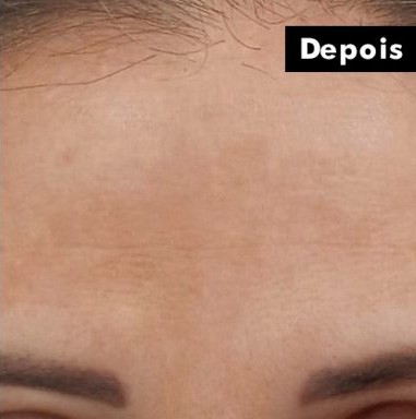 Antes e depois do clareamento facial